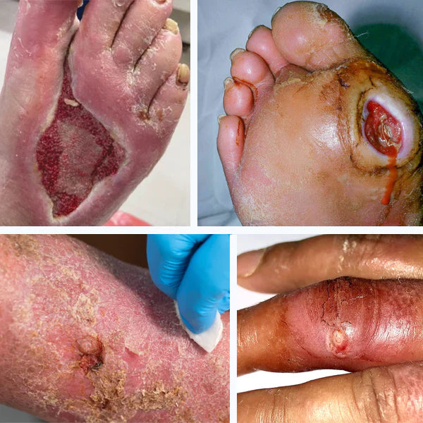 Cvreoz® Advanced Wound Healing Cream for Diabetic Skin 22 ULCERS